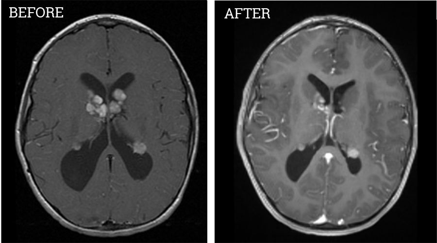 Griffen's brain scans before and after treatment.